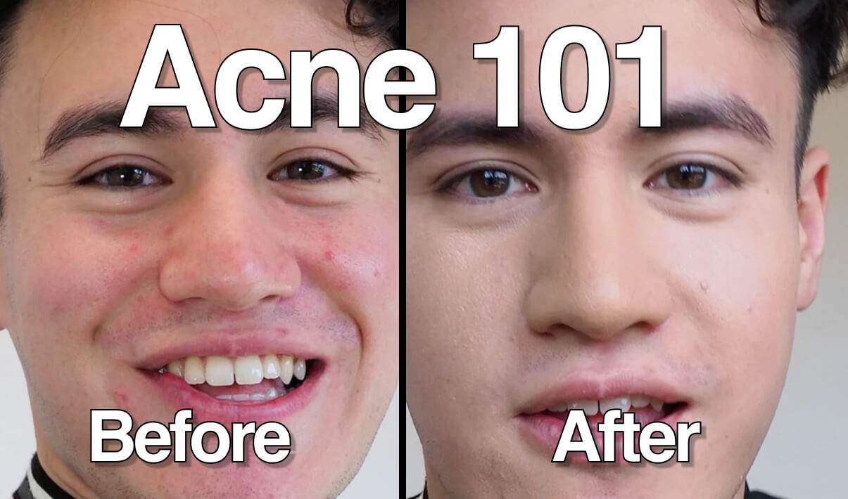 What Causes Acne? Acne 101: Understanding Breakouts blog image