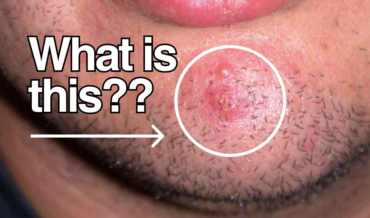 What Type of Acne Is This? Identifying and Dealing with Different Types of Acne blog image