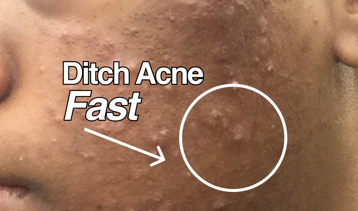 How Do I Get Rid of Acne Fast? A Pimple Care Cheat Sheet with Acne Spot Treatment blog image
